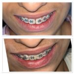 Befor and after image