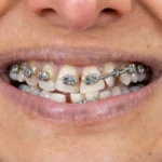 Traditional Metallic Braces