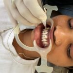 Braces Treatment 1